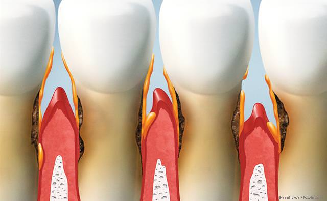 Bei einer Parodontitis wird der Zahnhalteapparat abgebaut
