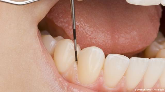 Untersuchung des Zahnbettes