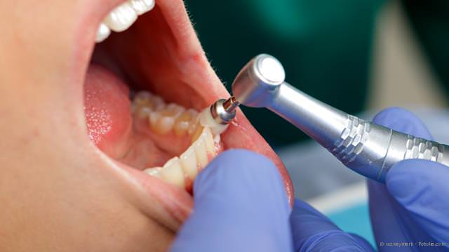 Vorbehandlung: Professionelle Zahnreinigung (PZR)